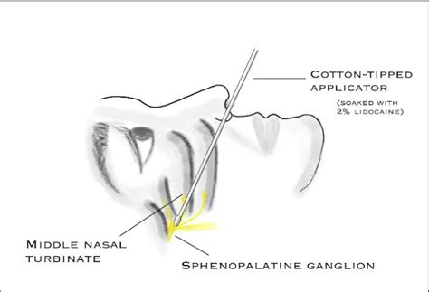 Technique Of Sphenopalatine Block Download Scientific Diagram