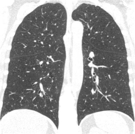 Visual Emphysema At Chest CT In GOLD Stage 0 Cigarette Smokers Predicts