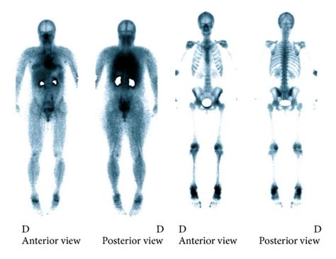 Bone Scintigraphy Performed Two Months After Partum Excessive Uptake Download Scientific