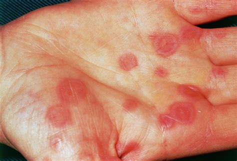 Erythema Multiforme Rash Photograph By Cnri Science Photo Library Hot