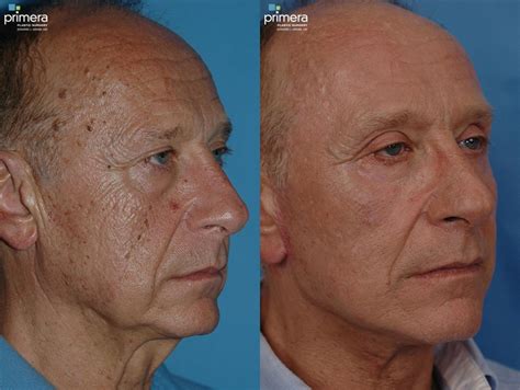 Laser Skin Resurfacing Dot Co Before And After Pictures Case