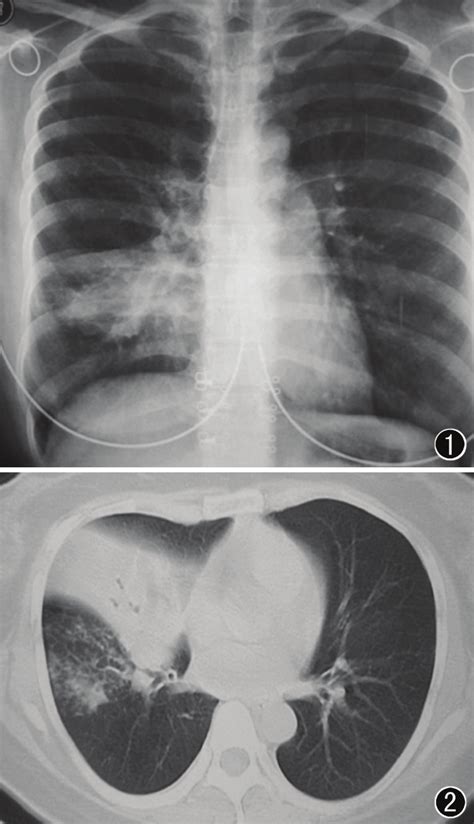 Right Middle Lobe Infiltrate Radiograph