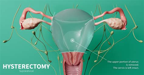 Types Of Surgical Procedures For Hysterectomy At Dylan Pridmore Blog