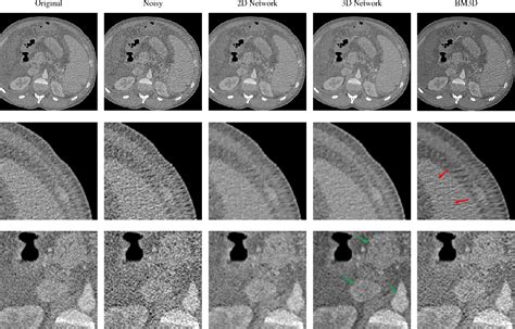 Figure 3 From Noise Reduction In Low Dose Ct Using A 3d Multiscale