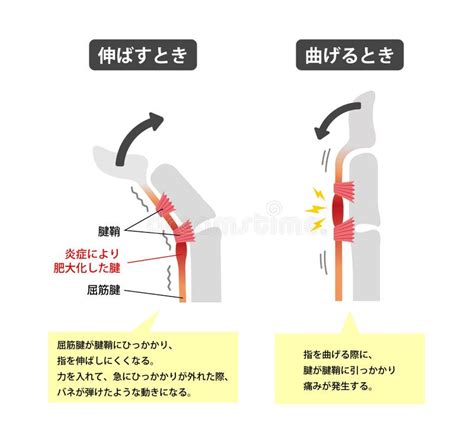 Trigger Finger Causes And Symptoms Illustration Stock Vector