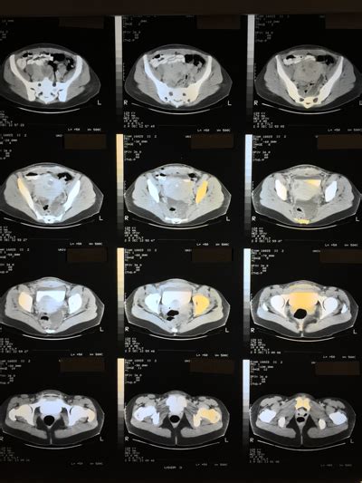 What is an Abdominal or Abdomen CT scan? | Two Views