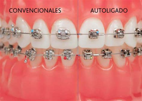 Tipos De Brackets Cl Nica Dental Fabi N L Pez