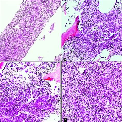 Tru Cut Biopsy Showing A Cellular Tumor Composed Of Plump Spindled