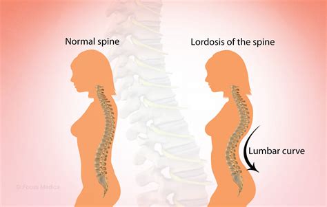 Lordosis Treatment Before After