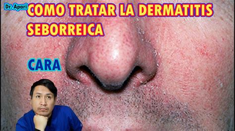 Como Tratar La Dermatitis Seborreica En Cara Dr Apari Youtube