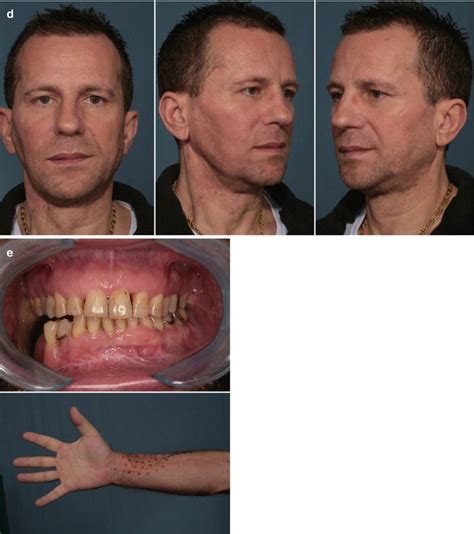 Secondary Correction of Facial Deformities Following Major Resection and Reconstruction: Fat ...