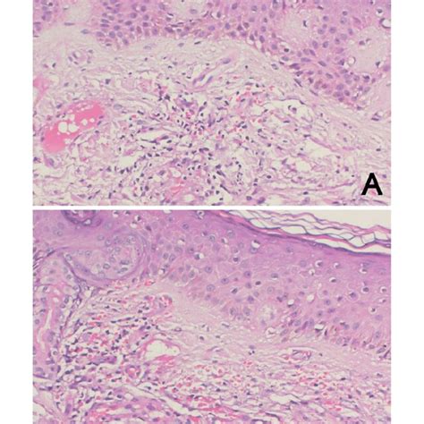 Microphotographs A And B Showing Superficial Dermal Perivascular