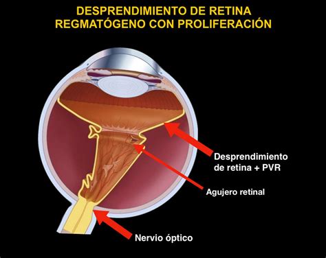 Desprendimiento De Retina Somos Retina Y M Cula Consultores