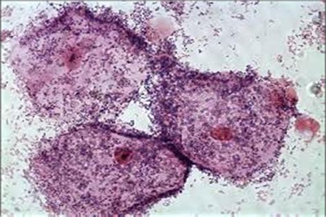 Figure From Clinical Presentation Diagnosis And Management Of