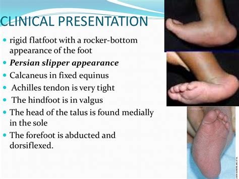 Congenital Vertical Talus Ug Lecture