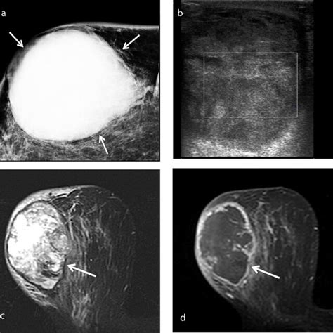 An Example Of Squamous Cell Metaplastic Breast Carcinoma In A Download Scientific Diagram