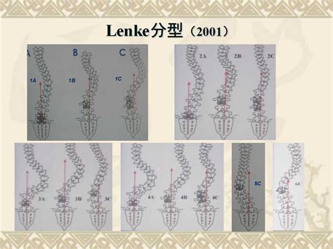 脊柱侧弯的治疗方法及对策 好医术早读文章 好医术 赋能医生守护生命