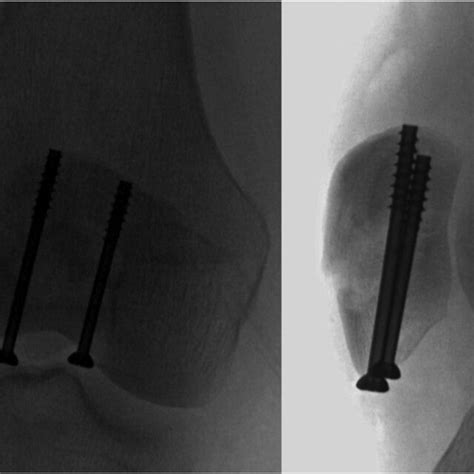 Final Anteroposterior Left And Lateral Right Fluoroscopic Views Of