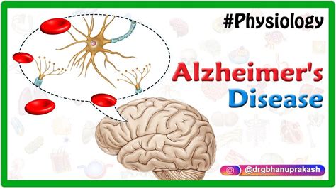 Alzheimer S Disease Etiology Pathophysiology Signs And Symptoms