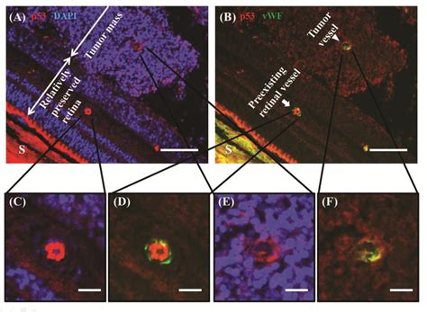 Figure 5 From Nuclear Expression Of P53 In Mature Tumor Endothelium Of