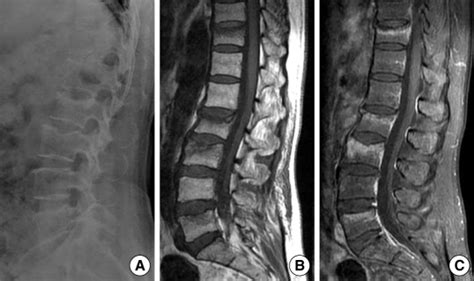 A Plain Radiographic Examination Of The Patients Thoracolumbar Spine