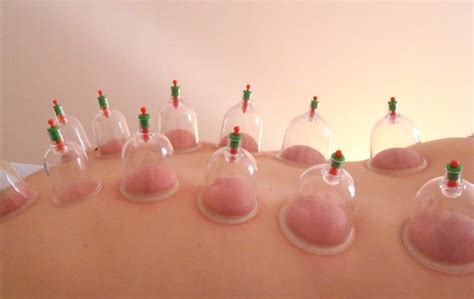 Conseils Pour La Pratique Du Cupping Th Rapie Nuitcalme