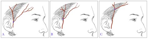 Surgical Anatomy Of The Superficial Temporal Artery To 51 OFF