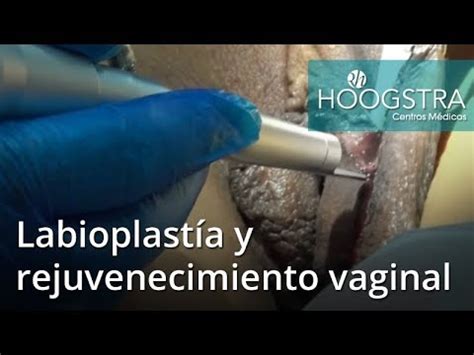 Labioplast A Y Rejuvenecimiento Vaginal Youtube