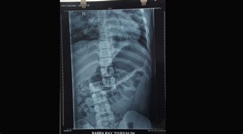 Crh Doctors Perform Complex Spine Surgery Shares Miraculous Recovery