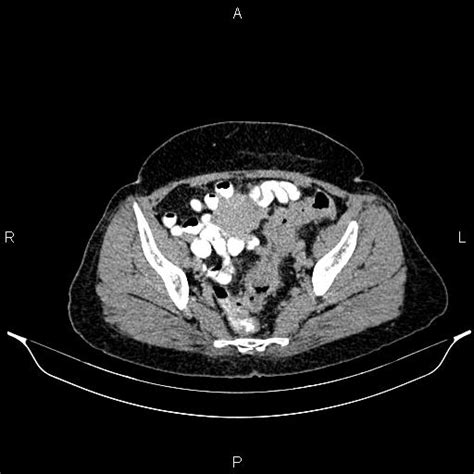 Metastatic Rectosigmoid Colon Cancer Image