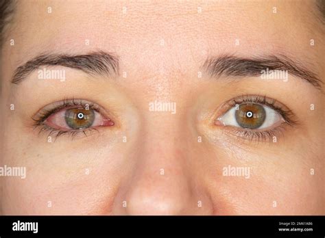 Primer Plano De Una Mujer Adulta Que Tiene Conjuntivitis O Ojo Rosado