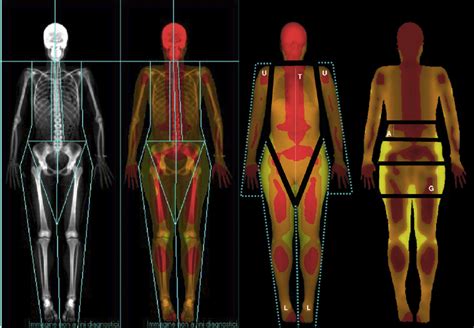 Dual Energy X Ray Absorptiometry Whole Body Analysis According To The