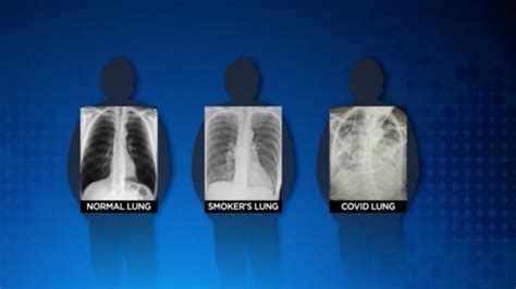 Surgeon: Post-COVID lungs ‘look worse’ than any awful smokers’ lungs - Boston News, Weather ...