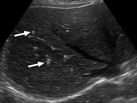 Cystic Lesions Of The Liver Ajr