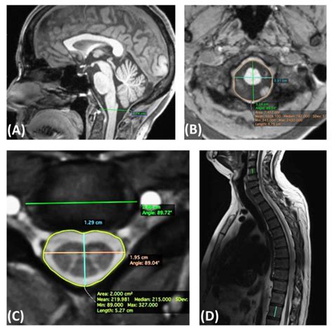 Definition Of The Skeletal Metrics A Sagittal T Weighted Mprage