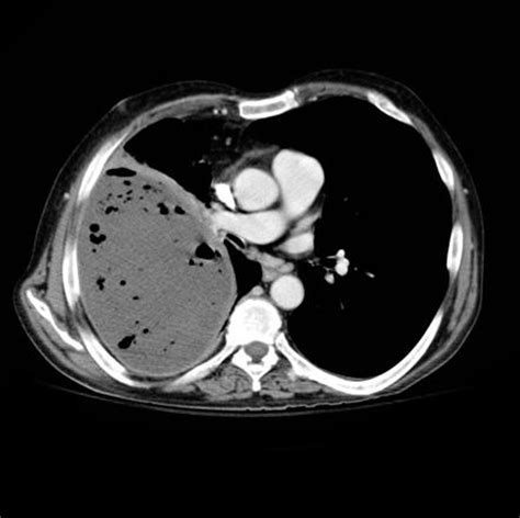 Lung Abscess Radiology Reference Article Radiopaedia Org