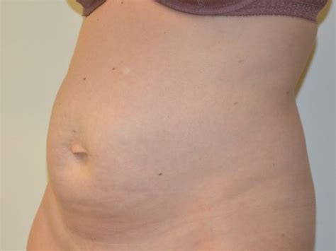 Tummy Tuck 29 Before After Gallery Allen Doezie MD FACS