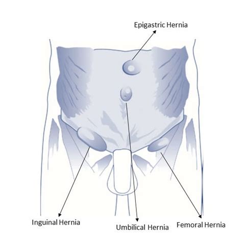 Hernia Surgery Independent Health Group England