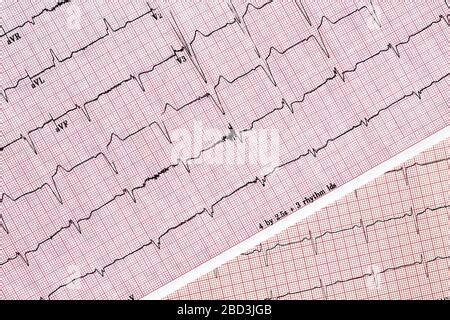 Gros Plan Du Rapport D Cocardiographie Ecg Montrant Une Pulsation