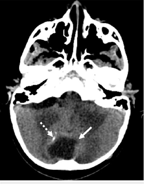 Axial Ct Soft Tissue Window Showing A Midline Posterior Fossa Cystic