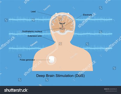 Neuromodulation Deep Brain Stimulation Dbs Subthalamic Stock Vector