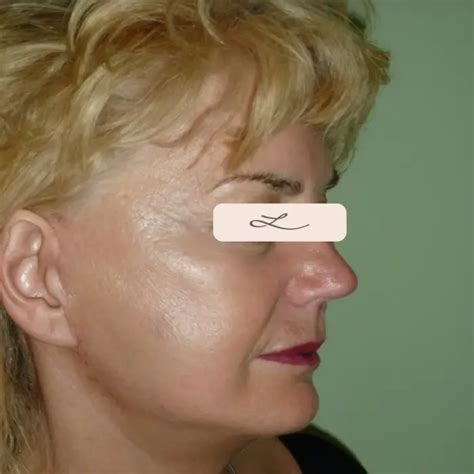 Lifting Facial Chirurgical Rezultate După 19 Zile Dr Lazar