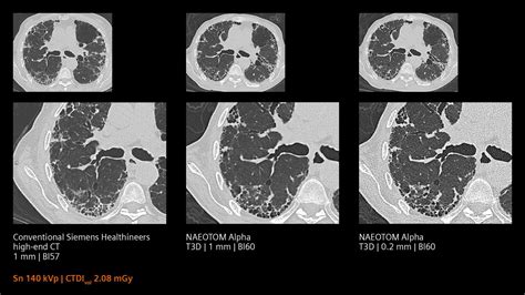 Pcct Pulmonology Imaging Siemens Healthineers