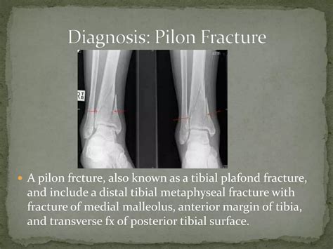 Pilon Fracture Ppt