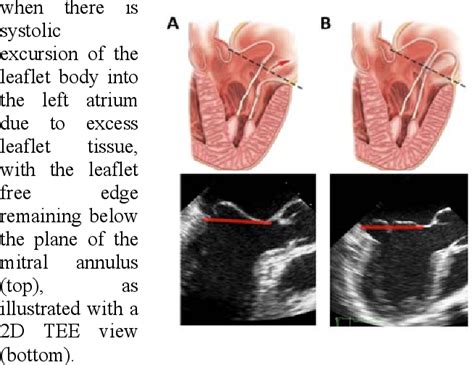 Figure From Role Of D Echocardiography Derived Color Coded