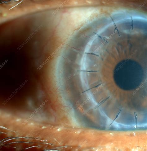 Corneal Transplant - Stock Image - C027/2019 - Science Photo Library