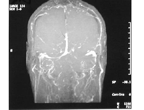 Angio Irm C R Brale Thrombose Du Sinus Longitudinal Et Du Sinus