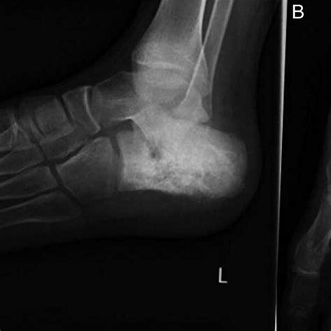 Lateral A And Anteroposterior B Views Of Plain Radiography Of The