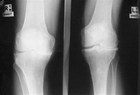 Platelet Rich Plasma (PRP) an Individual Account of Treating Knee Pain