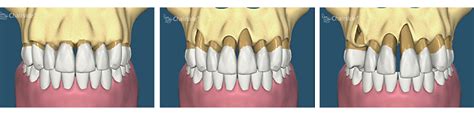 Gum Disease | Dream Dental Implant Center | Bone Loss